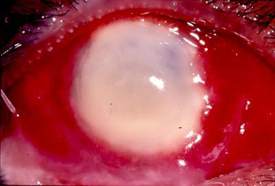 Fungal corneal ulcers Fungal ulcers of the cornea