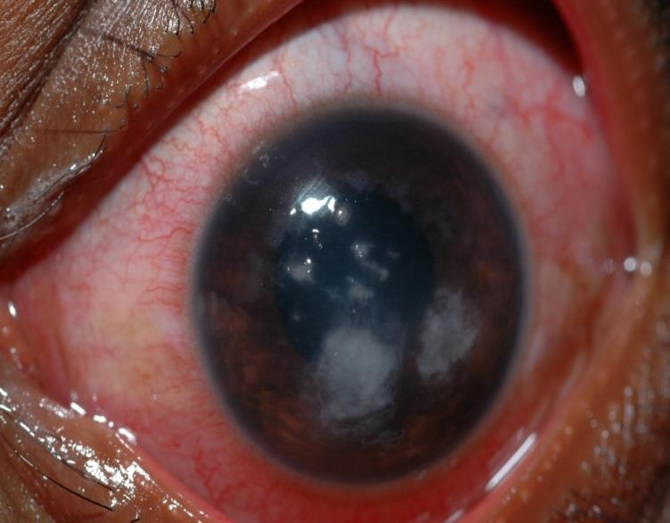 Fusarium and Aspergillus: Topical anti-fungal eye