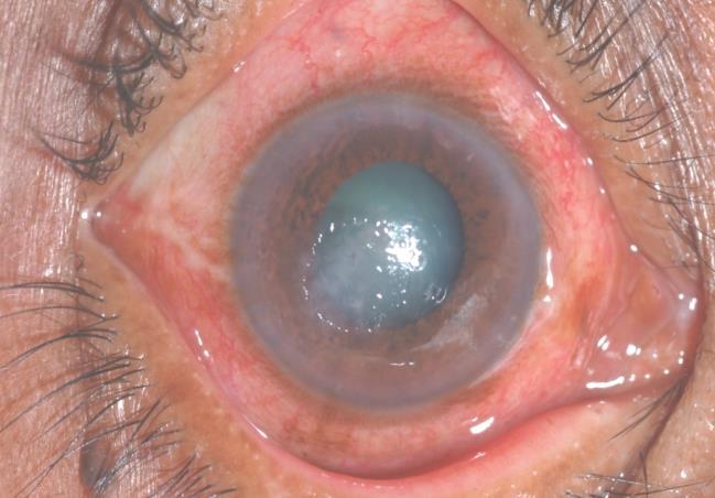 Fungal corneal ulcers The outcome of