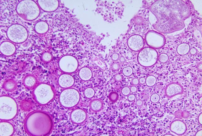 blepharitis, Cryptococcus neoformans after trauma Rhinosporidium seeberi Candida spp: