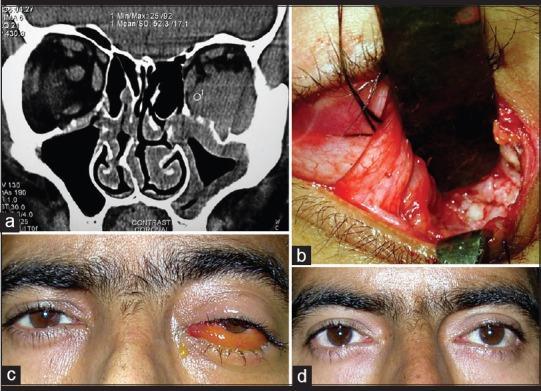 Fungal infections of the Obit Orbital fungal infections are vision-