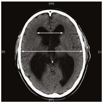 features of so-called disproportionately enlarged subarachnoid space hydrocephalus, i.e. tight high-convexity and medial subarachnoid spaces and enlarged Sylvian fissures (Hashimoto, Ishikawa, Mori, & Kuwana, 2010; Virhammar et al.