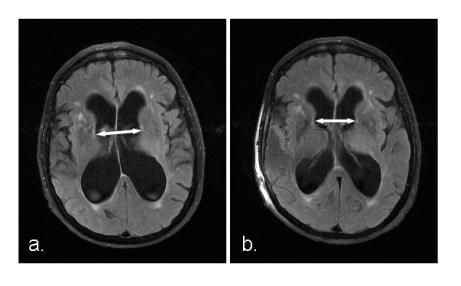 Figure 3.1: Measurement of bicaudate ratio on MRI axial flair An illustration of BCR before (a.) and following (b.) shunt surgery.