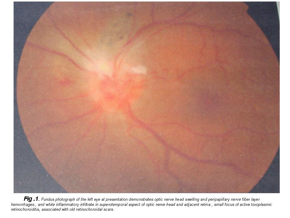 hyperplasia. 3 Anterior uveitis is a common finding, with mutton-fat keratic precipitates, fibrine, cells and flare, iris nodules and posterior synechiae.