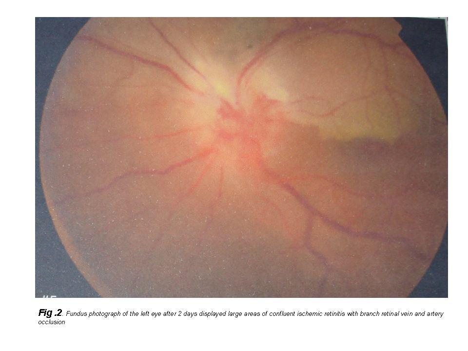 retinopathy, Fuchs'-like anterior uveitis, scleritis and multifocal or diffuse necrotizing retinitis.