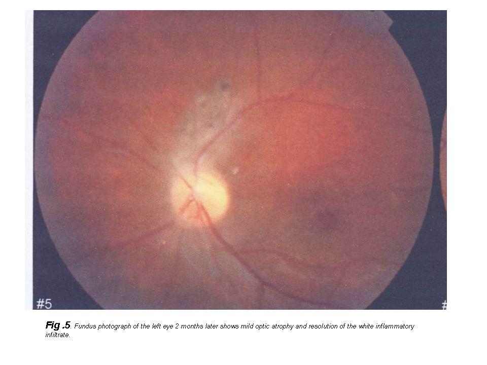 DISCUSSION In English literature, only a few well documented cases of papillitis and acute toxoplasma retinochoroiditis without branch retinal artery and vein occlusion are reported.