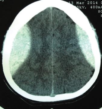 Epidural Hematoma Treated Conservatively: When to Expect the Worst. Can J Neurol Sci. 2016;43(1):74-81. 3. Bejjani GK, Donahue DJ, Rusin J, et al.