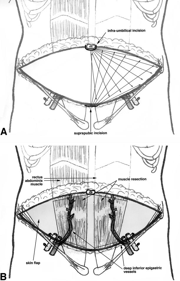 Effect of liposuction on perforator vessels in the abdominal wall 267 into the subcutaneous fat of the flap, until a tumescent state was reached.
