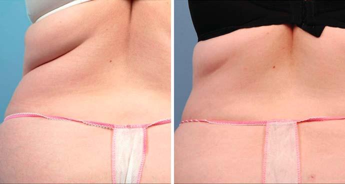 11 Body shape appearance of a female patient before (left) and 6 months after treatment (right) Fig.