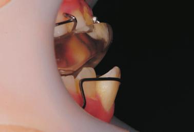 Kim et al Profile predictors for Twin-block INTRODUCTION Skeletal Class II malocclusion can result from either maxillary protrusion, mandibular retrusion, or a combination of the two.