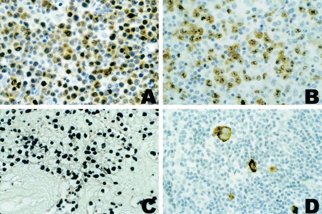 k.a. cyclin D1) protein overexpression by immunohistochemistry in mantle cell lymphoma is an excellent surrogate marker for the t(11;14) and reduces the need for the PCR detection method.