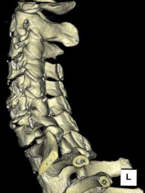 atrophy of the posterior cervical muscles compared with
