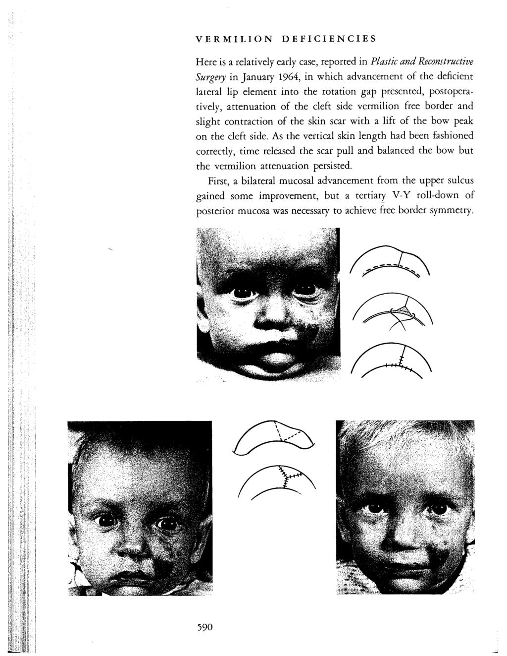 VERMILION DEFICIENCIES HERE IS RELATIVELY EARLY CASE REPORTED IN PLASTIC AND RECONSTRUCTIVE SURGE IN JANUARY 1964 IN WHICH ADVANCEMENT OF THE DEFICIENT LATERAL LIP ELEMENT INTO THE ROTATION GAP