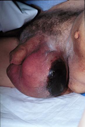 Necrotizing fasciitis of the perineum (Fournier's gangrene) can involve the scrotum.