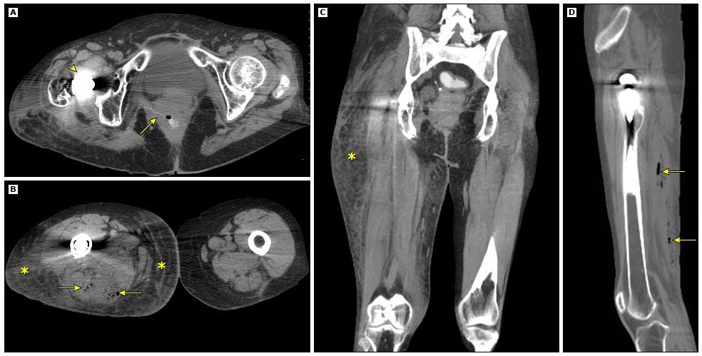 An axial CT scan through the lower pelvis (A) in a patient with Crohn's disease and a right hip replacement (arrowhead) shows a fistulous tract (arrow) from the rectum to the soft tissues of the