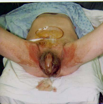 TYPE 1 INFECTIONS Fournier s Gangrene Perineum Preceded by