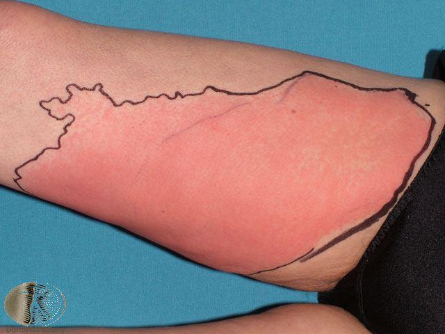 Cellulitis Clinical Local inflammation, tenderness, warmth, erythema,