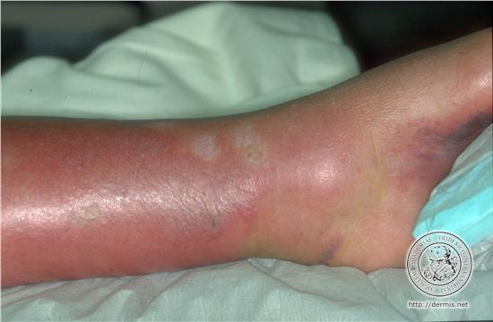 Erysipelas Superficial cellulitis with lymphatic involvement Usually from Group A
