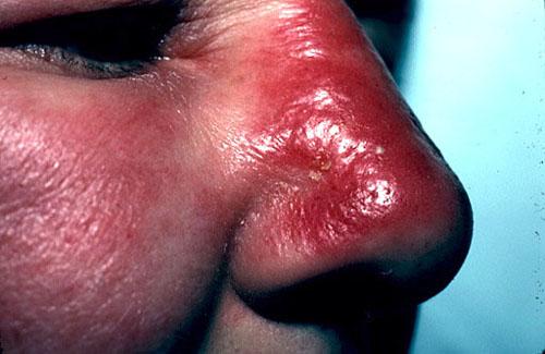 Erysipelas Clinical Abrupt onset High fever, chills, malaise and nausea prodrome Area of