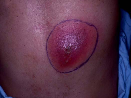 Cutaneous Abscesses Treatment Incision and drainage Antibiotics Always in high risk groups