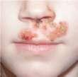 Impetigo Most often caused by: Streptococcus pyogenes/ Group A S.