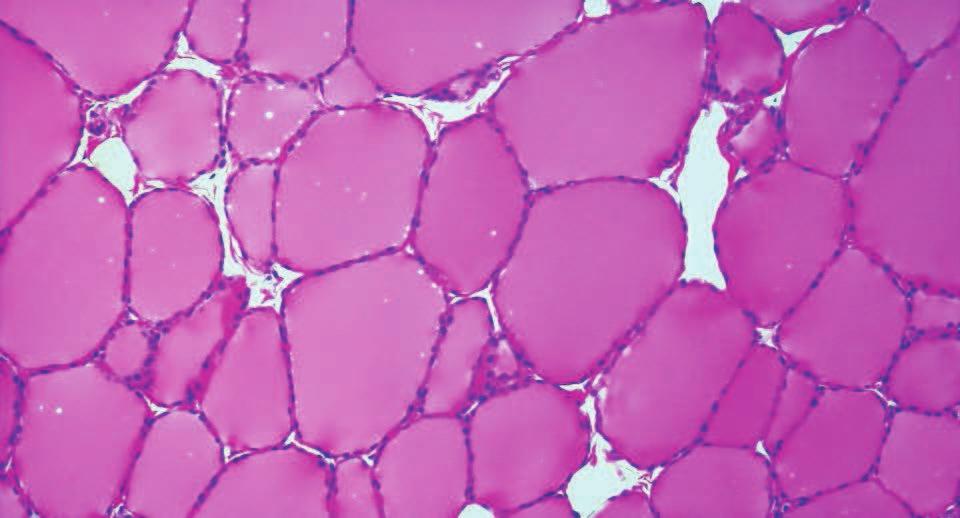 Thyroid Change Microscopic
