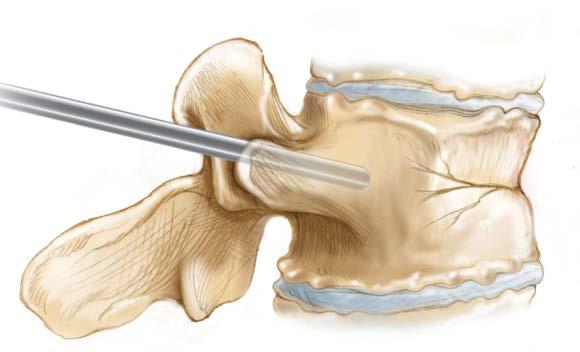 Minimally Invasive Surgery Vertebroplasty Uses local, moderate sedation, or general anesthesia 11g-13g needle guided into the fractured vertebra Bone cement injected into the