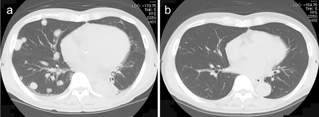 Figure 3. Chest CT shows multiple metastatic lesions of HCC in the lungs (a). No nodules were found after eight courses of TAI combined with BAI (b). Figure 4.
