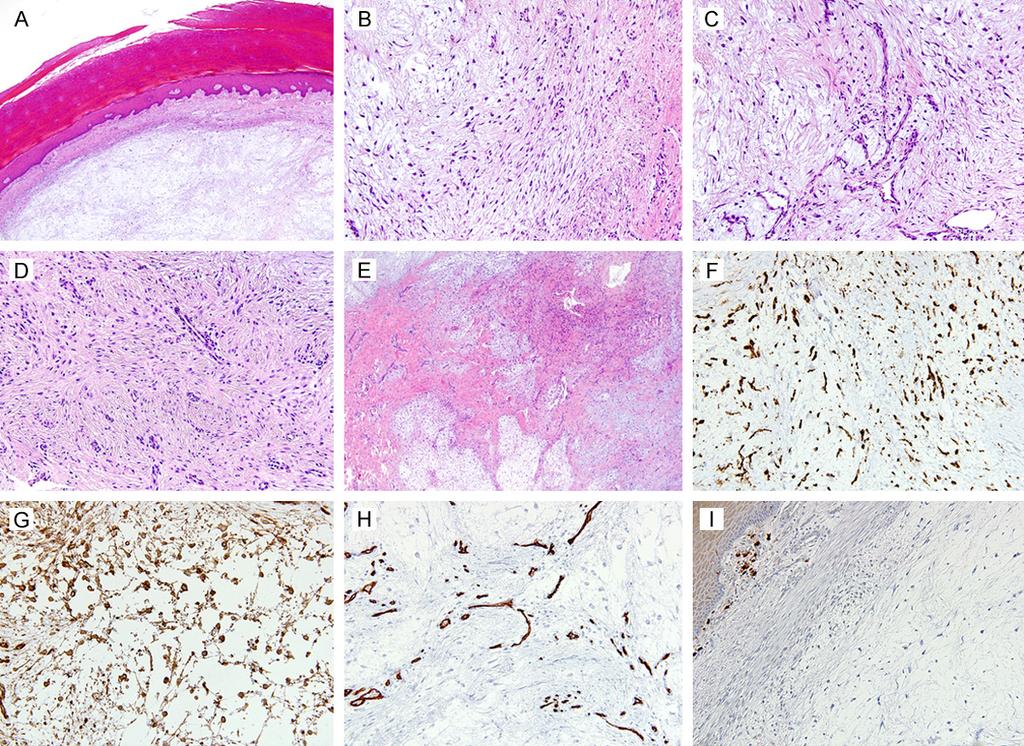 Figure 1. Histopathological and immunohistochemical findings. A. A relatively well-circumscribed, unencapsulated cutaneous tumor was observed, with a small grenz zone towards the epidermis. B.