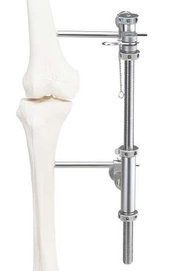 Standard Femoral Distraction Alternate applications The Large Distractor can be helpful for fractures involving the tibial