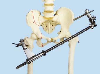 The distractor aids preoperative and intraoperative repositioning and also provides temporary fixation.
