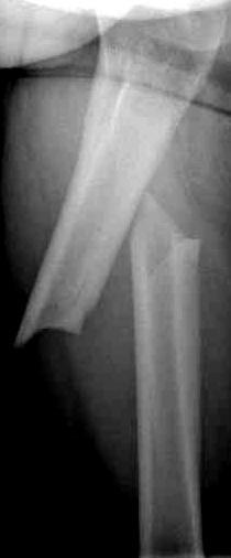 Atypical femoral fractures Comprise 1% of all femoral fractures Increase with duration of