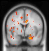 PTSD participants viewing fearful facial expressions during fmri R