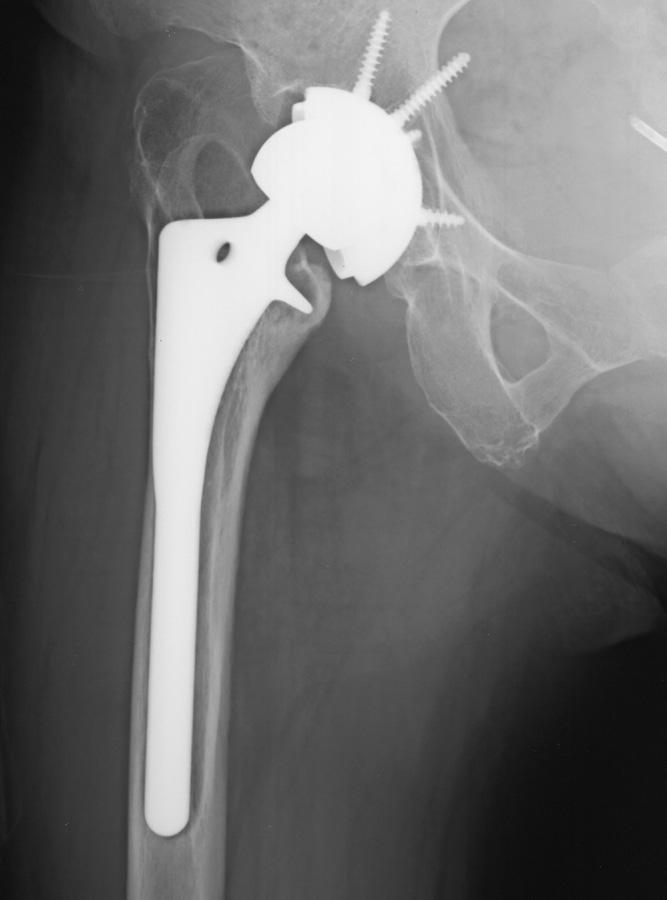 Extensively Porous-coated Stems for Femoral Revision: Reliable Choice for Stem Revision in Paprosky Femoral Type III Defects Lien-Hsiang Chung, MD; Po-Kuei Wu, MD; Cheng-Fong Chen, MD; Wei-Ming Chen,