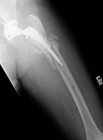 Bugbee et al 24 reported a 23% stress shielding rate; however, no femoral components were associated with clinical or radiographic evidence of loosening.