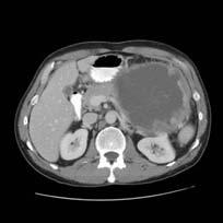 Oncology and Nuclear Medicine Disclosure Case I 53-year-old male presents with UGI bleed Transfused 2 units of blood EGD shows gastric ulcer related
