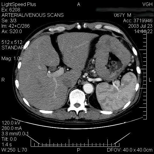 Management CT scan before chemo Surgery- localized disease, young patient, emergency presentation, avoid for diagnosis only, if in OR frozen section and clips Radiation limited by GI toxicity and