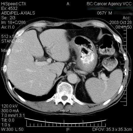 tumour 100% local control cf 60% if >6 cm Overall complete response in 50% 3 year disease free 46% Case VI 27 y.o. female, no significant medical history 1 wk history of epigastric pain and melena.