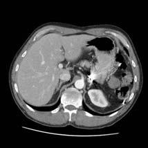 Postoperative CT Scan Pathology Report 20 cm high grade GIST Spleen not involved with tumour Extensive necrosis and hemorrhage within tumour Pseudocapsule intact, gastric margins clear 1 6 Follow-up