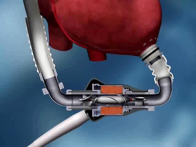 Background The left ventricular assist device (LVAD) is a mechanical internal heart pump used to treat heart failure.