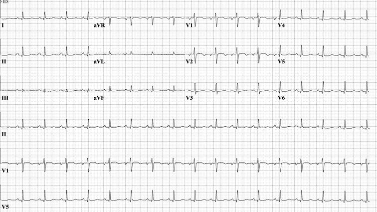 57 year old Female, retired CFO with Chest Pain,