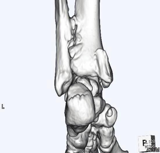 Three-dimensional computed tomography (3D-CT) revealed tibial bone hyperplasia along the posterior tibial tendon (Figure 2).