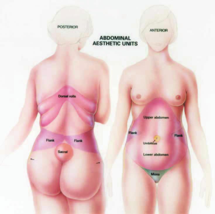 Figure 1. The female abdomen consists of 7 aesthetic units. additional improvement or referred to these adjacent areas during consultation for such surgery.