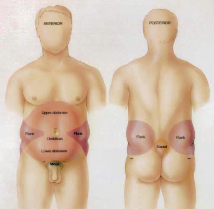Figure 2. The male abdomen consists of 6 aesthetic units. Men are rarely concerned with dorsal back rolls. (Note the proposed 5 stab incision sites for access.) The mons pubis is one of these units.