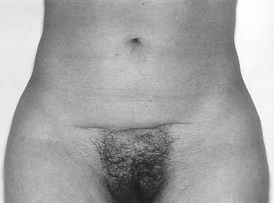 concern for improvement of multiple aesthetic units of the abdomen, including the mons.