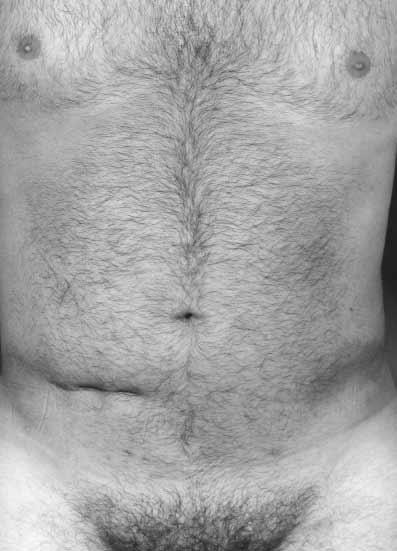 C D Figure 7., C, Preoperative appearance of a 31-year-old man after lipoplasty of the abdomen.