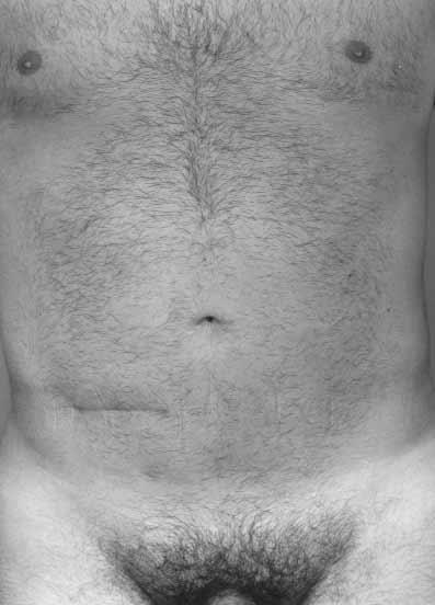 including the mons pubis, as well as a revision of a lower abdominal scar.