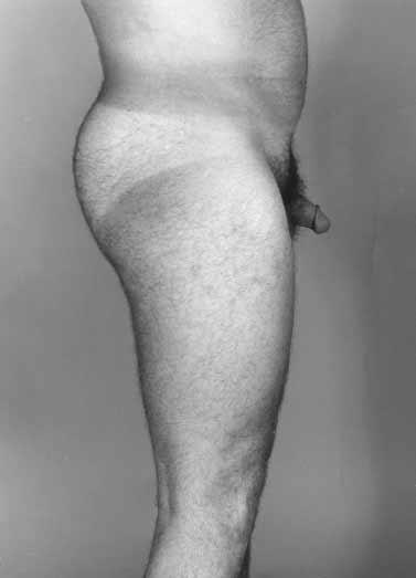 protuberant mons pubis and aids in final contouring to provide balance of the abdominal aesthetic units. References 1.