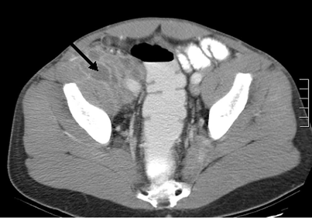 478 CRUM-CIANFLONE CLIN. MICROBIOL. REV. FIG. 1. CT scan showing multiloculated primary iliopsoas abscess (arrow) due to group A streptococci in an HIV-infected patient.