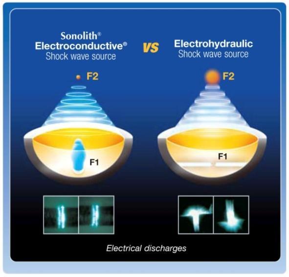 EDAP TMS Electroconductive technology - Principle